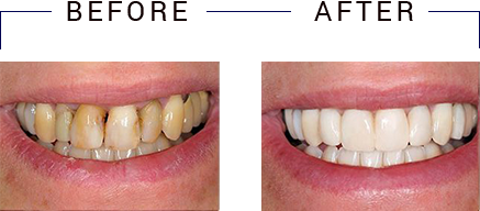 Dental Implants Dentist in Deltona